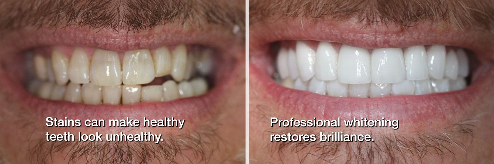 Before and after teeth whitening